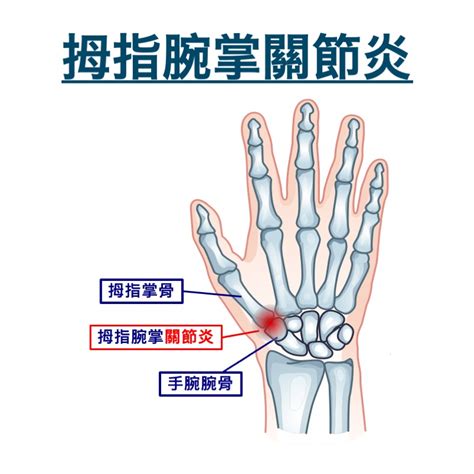 第一掌指關節|手部關節炎 